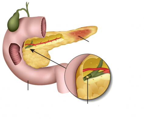 pancreatita este o inflamație a pancreasului